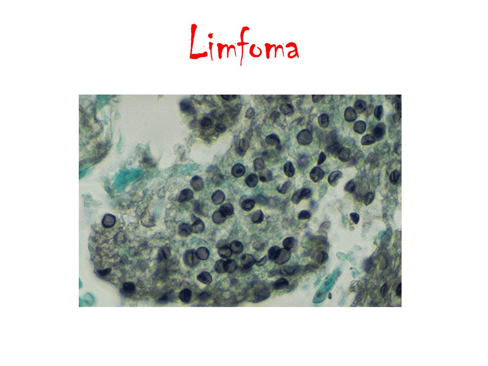 Foto sinar-X paru-paru pada pneumonia yang disebabkan oleh Pneumocystis jiroveciisinar-XPneumocystis jirovecii