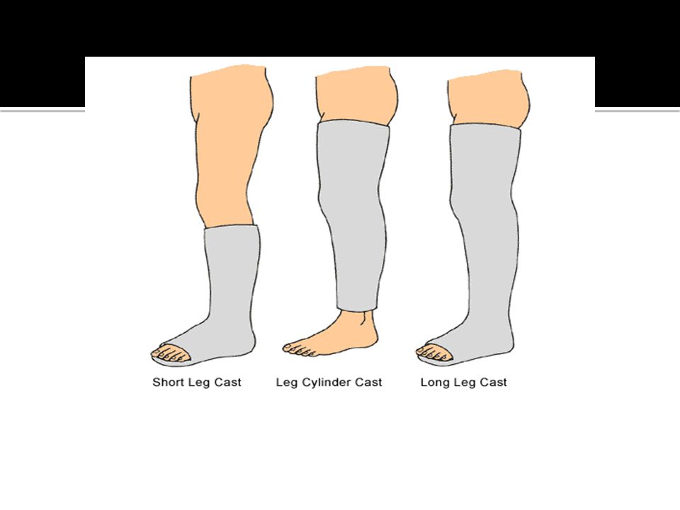 Types of Legs. Leg Cast Socks. Leg Cast svg. Animated Cast Leg Manga.