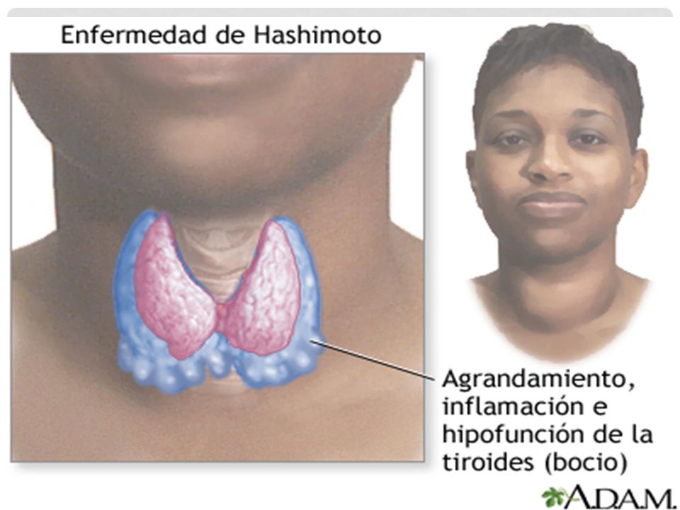 Tiroiditis síntomas