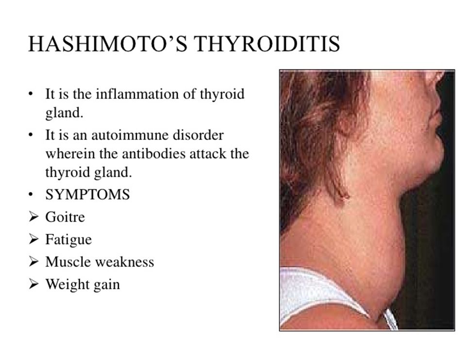 Хашимото болезнь у женщин. Аутоиммунный тиреоидит зоб Хашимото.