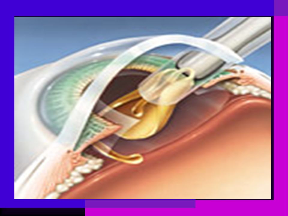 Операция факоэмульсификация катаракты. Катаракта факоэмульсификация. Аккомодирующие ИОЛ. Искусственные интраокулярные линзы (ИОЛ).