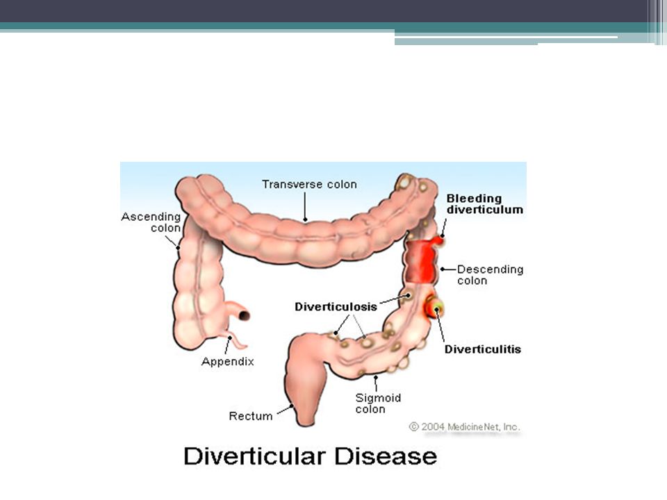 Дивертикулез сигмовидной кишки диета лечение. Дивертикулярная болезнь и дивертикулит. Дивертикулит Толстого кишечника. Патогенез дивертикулярной болезни толстой кишки. Дивертикулит этиология.