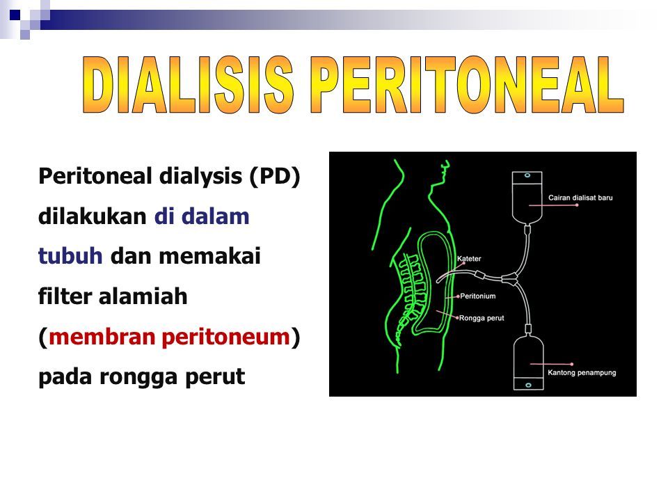 Peritoneal dialysis (PD) dilakukan di dalam tubuh dan memakai filter alamia...